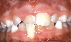 Crossbite of front teeth